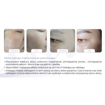 Mjolnir - Plazma frakcyjna - lifting -Lifting, zabieg liftingujący- 