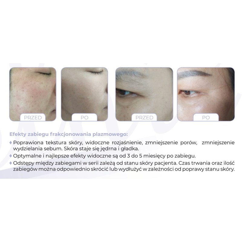 Mjolnir - Plazma frakcyjna - lifting -Lifting, zabieg liftingujący- 