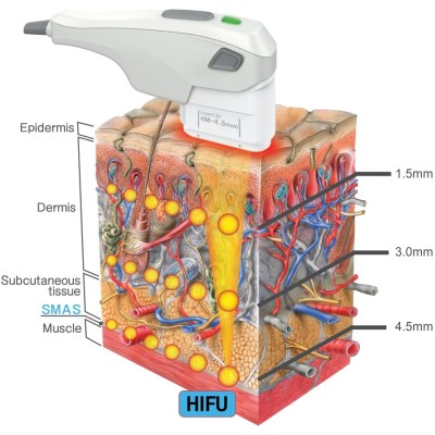 HS 1115 - HiFU Contlex™ -Ultradźwięki, zabiegi ultradźwiękowe- 